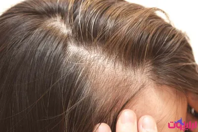 علت نازک شدن تار مو چیست؟