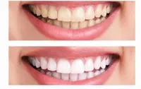 نکات مهم سفید‌کردن و جرم‌گیری دندان‌ها